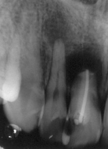 endodoncija-1 (2)